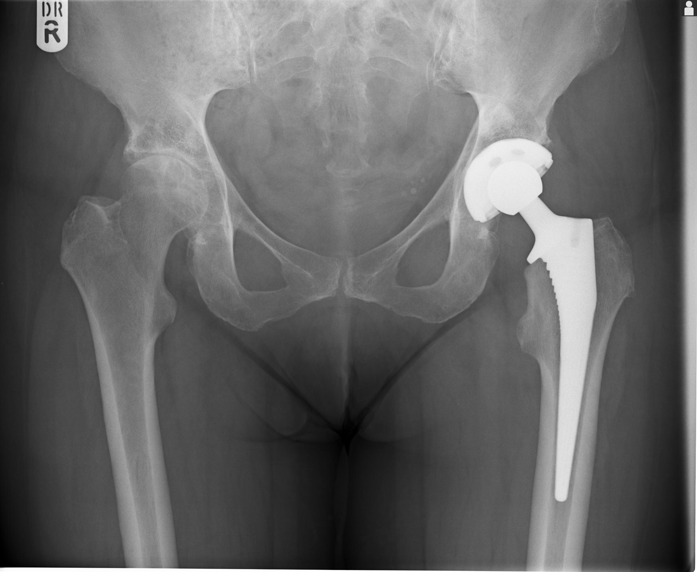 Bilateral Hip Resurfacing